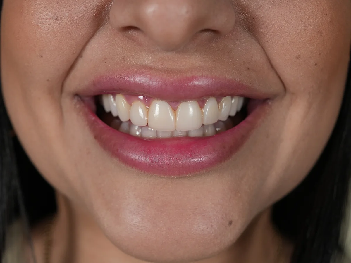 Before — Carillas Dentales — Smile Dental Center